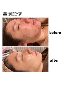 エステティックレイビス 名古屋店(RAYVIS)/大人気ニキビケア♪