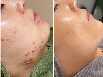 ピブ(PIBU)/男性ニキビ/ハーブピーリング