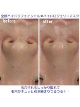 クラリ(Clari)/毛穴/毛穴洗浄/ハイドラ