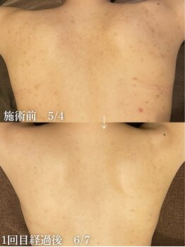 ハーブのほし/背中のニキビケア・シミケア