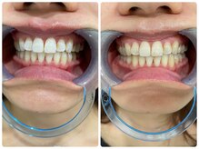 コナホワイトニング 神保町/セルフホワイトニング神保町