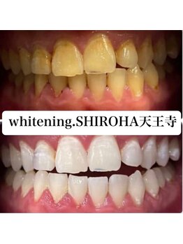 シロハ(SHIROHA)/セルフホワイトニング/天王寺