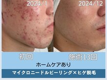 アロマ(AROMA)/　ニキビ・凹凸跡・毛穴改善