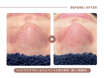 イエス マイサロン(yes My Salon)/毛穴洗浄症例
