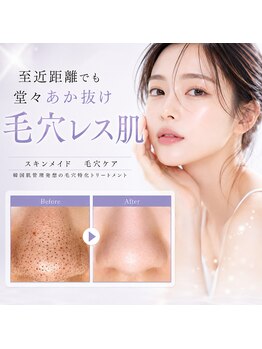 エイル(EILE)の写真/ファンデで隠す毛穴、もう卒業しませんか?韓国の「トロイアルケ」で、毛穴汚れも悩みもリセット!