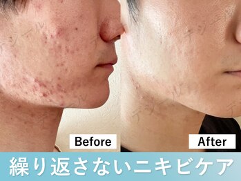 デジールの写真/肌悩み男性必見◆メンズ水光ピールでニキビ・毛穴を根本改善！本格施術をお届けするメンズ専門店