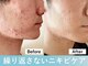 デジールの写真/肌悩み男性必見◆メンズ水光ピールでニキビ・毛穴を根本改善！本格施術をお届けするメンズ専門店