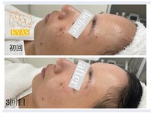 キャス(KYAS)/プラチナクレイピール施術3回目!