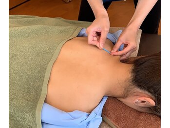 シシラ(shishira)/【ピンポイントケア】鍼ケア！