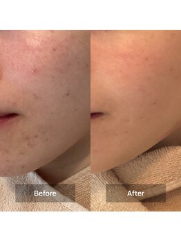 モカ 天王寺店(MOKA)/ホホニキビケアハーブピーリング