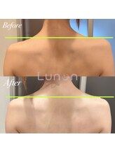 ルノン(Lunon)/ブライダルエステ