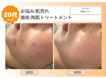 ムーンサン(Moon sun)/20代メンズ＊陶肌トリートメント