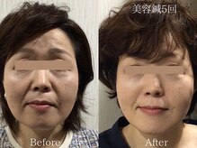 ひじ鍼灸整骨院/美容鍼Before /After◎