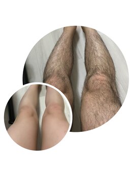 グロワール(gloire)の写真/脱毛シーズン到来☆今まで隠してた体毛や、剃っても剃っても終わりのない【生涯続く面倒な毛の処理は卒業】