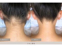 ミランジュ 新瑞橋(miranju)/うなじ脱毛