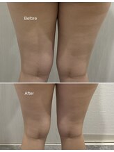 セラス(CERAS)/フォースカッター　太もも30分