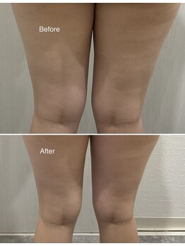 セラス(CERAS)/フォースカッター　太もも30分