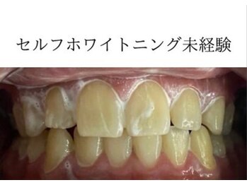 サロンドウルス(salon de ours)/セルフホワイトニング