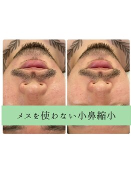 ソルニス(Solnis.)/【小鼻】針を使わない脂肪撃退