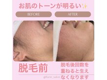 ファーレイン 長崎市の雰囲気（顔脱毛で化粧ノリUP！トーンUP/おすすめです♪）