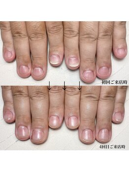 メンズ深爪矯正　長さ出し