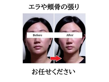 みなと/顔の横幅やエラ張りにも◎