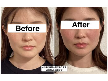 グリーン鍼灸整体院(green鍼灸整体院)/美容鍼