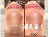 【小鼻黒ずみ悩みの方はこちら】毛穴洗浄付き【全顔】剥離有ハーブピーリング
