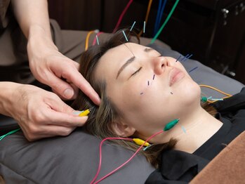 ハナレ(HANARe)の写真/HANARe独自の美容鍼もおすすめ！不眠改善だけでなく、美容効果も得られる極上ケアをぜひご体験ください♪