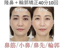 ラプリ 梅田店(Raplit)/隆鼻＋輪郭矯正40分10回