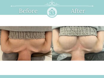 美人バスト 柏店/【バストアップ・育乳】症例