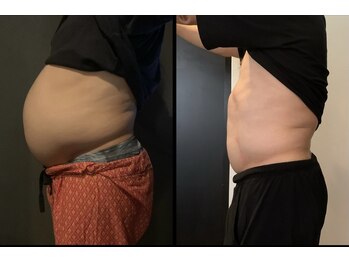 サラ(Sala)/【高周波機器】WINBACK