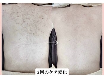 スキンハピネス(skinhappiness)/背中ハーブピーリング