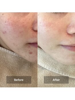 モカ 天王寺店(MOKA)/ホホニキビケアハーブピーリング