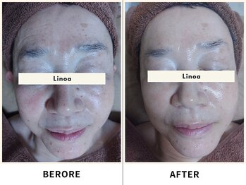 リノア(Linoa)/before/after