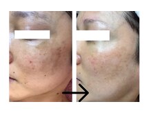 コトハ(cottha)/シャルムボー肌改善