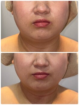 アンヴィオ ギンザコウフ(Anvio GINZA KOFU)/レモンボトルビフォア→アフター