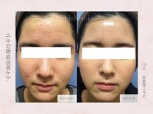 エピア 西尾店(Epia)/【U24・ニキビケア】