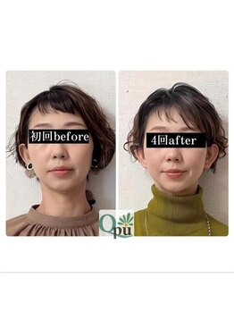 キュープ 大阪中百舌鳥店(Qpu)/左右差を整える