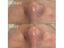 フロラスキン 横浜店(florasKIN)の雰囲気（【フローラ毛穴洗浄】１回の施術でここまでスッキリ♪）