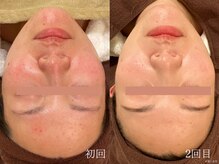 ウォーム(warm)/乾燥/敏感肌/赤み/フェイシャル