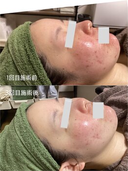 ブライトリー(Brightly)/本気の肌質改善!