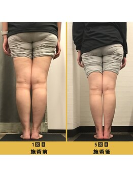 ベル/【40代会員様】O脚矯正の変化