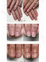 ティアラネイル 宇都宮/深爪矯正