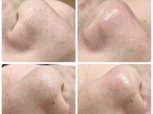 ミカエラ(MIKAELA)の雰囲気（毛穴汚れ除去）