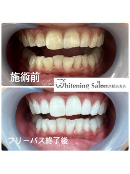 ホワイトニングサロン 京都烏丸店/ホワイトニング施術例