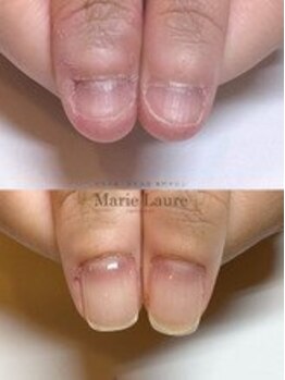 マリーロール 梅田店(Marie Laure)/自爪育成/深爪矯正/ネイルケア