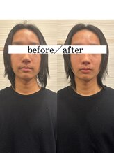 長寿鍼灸院 長寿整骨院/men's美容鍼50本効果★