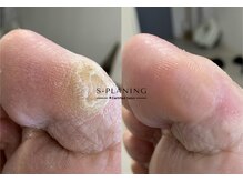 ロンディネ(Rondine)/足裏角質ケア足裏角質ケア37