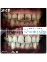 ホワイトニングサロン 福岡天神店/ホワイトニング